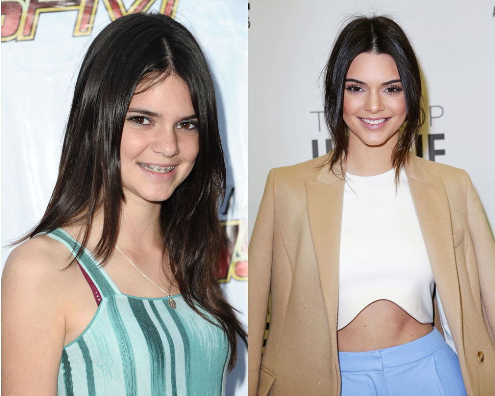 Kendal-Jenner-with-braces