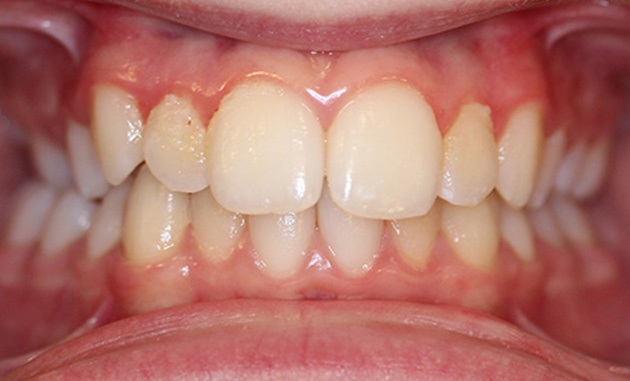 Front View With Invisalign On