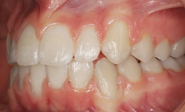 Left View With Invisalign On
