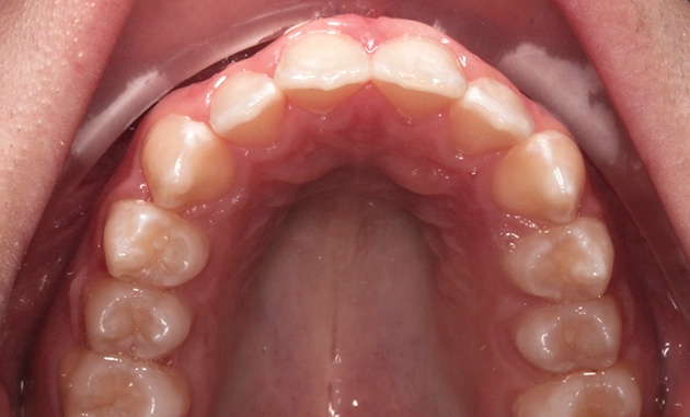 Upper Teeth